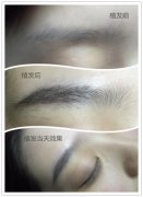 【高端技术培训】国际艺术无痕无痛毛发移植创